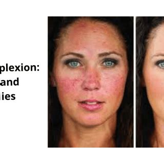 Causes of Ruddy Complexion Archives | Daily Health Cures