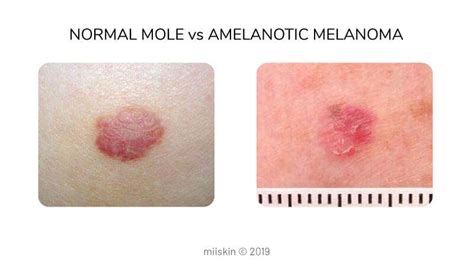 Amelanotic Melanoma