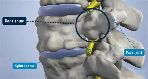 Bone Spurs - USA Spine Care - Laser Spine Surgery