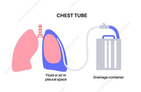 Chest tube catheter, illustration - Stock Image - F041/5939 - Science Photo Library