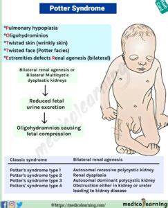 Potter Syndrome – MedicoLearning