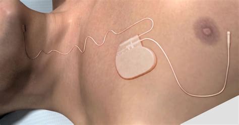 New sleep apnea device gets FDA approval - Videos - CBS News