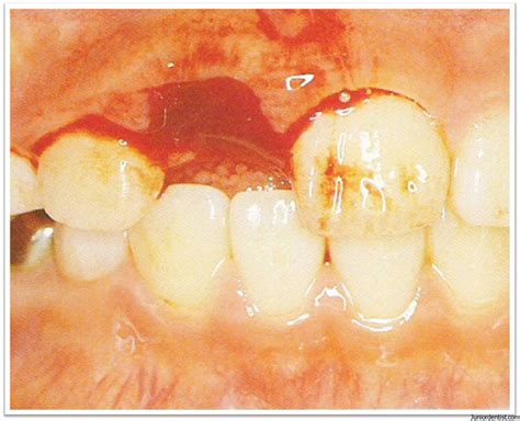 dental zone: Avulsion of tooth