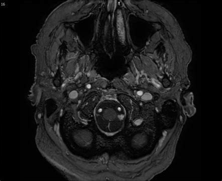 Benign enhancing foramen magnum lesion | Radiology Reference Article | Radiopaedia.org