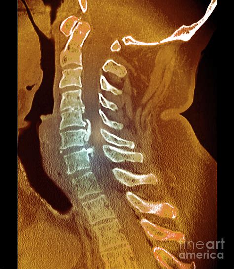 Osteoarthritis Of The Cervical Spine Photograph by Zephyr/science Photo ...