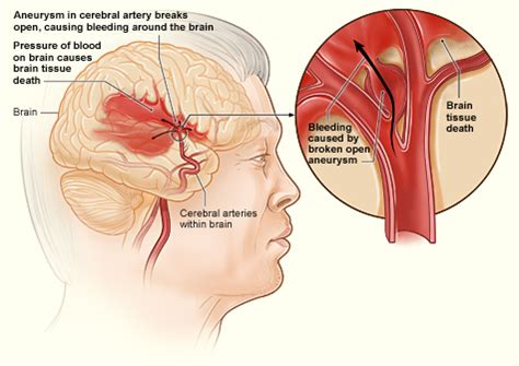 Brain Aneurysm: Treatment & Recovery | Study.com