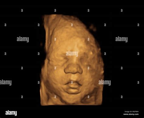 Foetus' face, Coloured 3-D ultrasound scan of a foetus, Gestational age : 31 weeks and 4 days ...