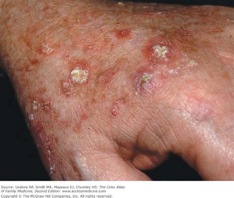 Actinic Keratosis and Bowen Disease | Basicmedical Key