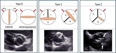 Aortic Valve Echo