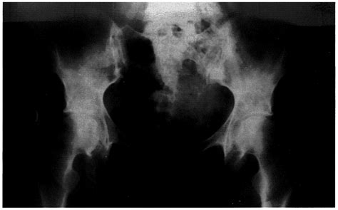 Periacetabular osteopenia in left hip. | Download Scientific Diagram