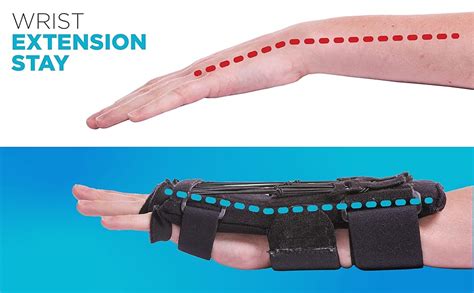 BraceAbility Radial Nerve Palsy Splint - Dynamic Brace for Wrist Drop ...