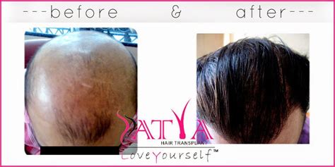 Satya Skin And Hair Transplantation: How to look smart with Biofibre ...