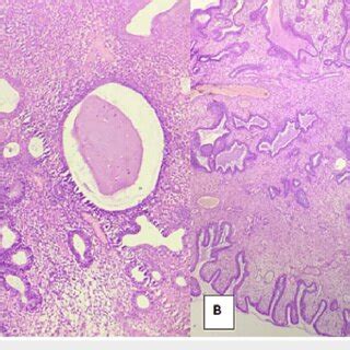 Disordered proliferative endometrium and endometrial polyp A:... | Download Scientific Diagram