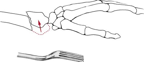 Orthopedic Management of the Wrist and Hand | Clinical Gate