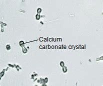 Calcium carbonate crystals | Medical Laboratories