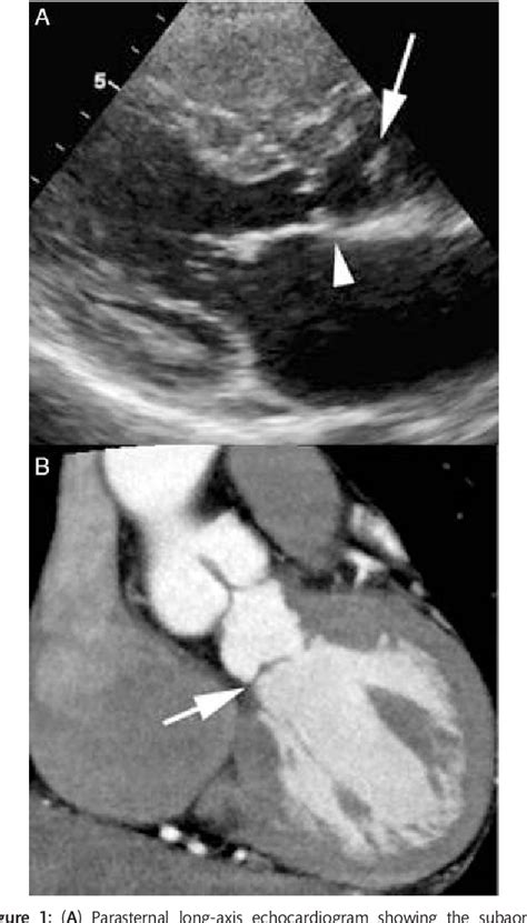 Figure 1 from Discrete subaortic stenosis 37 years after repair of a ...