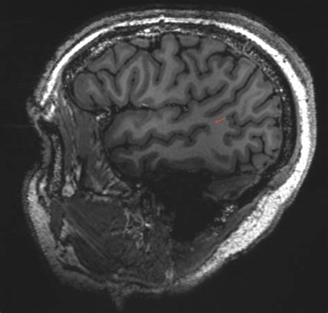 Gyrus angularis - Ars Neurochirurgica