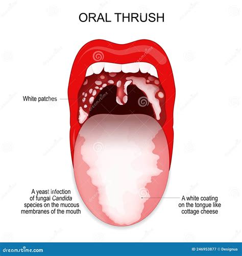 Oral Thrush. Candidiasis On The Tongue. Fungus In The Mouth. Infographics. Vector Illustration ...