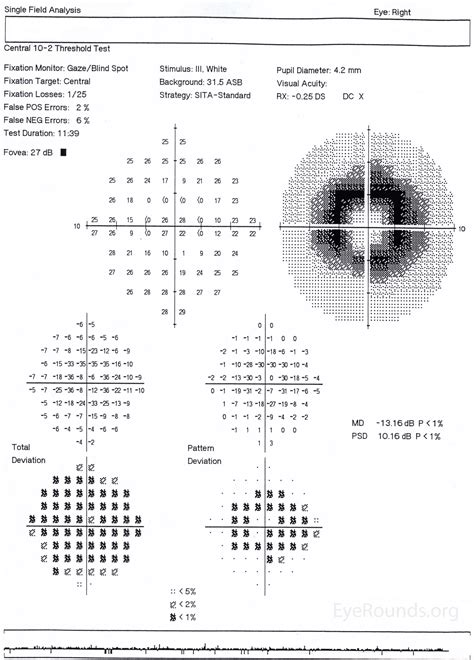 Bull's-eye maculopathy due to hydroxychloroquine toxicity