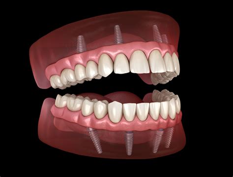 All-on-4 Dental Implants - Memphis, TN - Southern Dental Implant Center