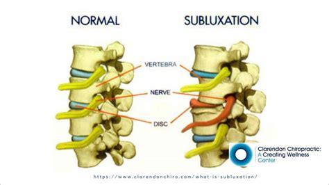 What is Spinal Subluxation? - Clarendon Chiropractic