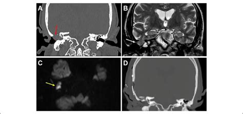 Preoperative computed tomography (CT) and magnetic resonance imaging... | Download Scientific ...