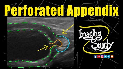 Perforated Appendix Ultrasound