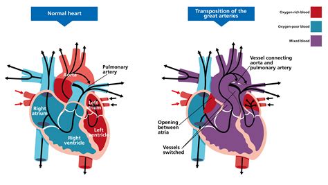 Transposition of the great arteries — Knowledge Hub