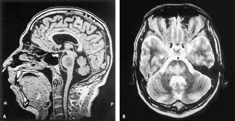 35A,B. Central pontine myelinolysis. A Sagittal SE T1-WI. B Axial TSE... | Download Scientific ...