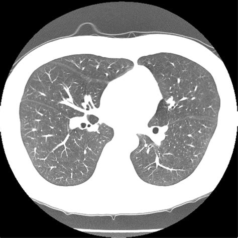 Abnormal Chest Ct Scan