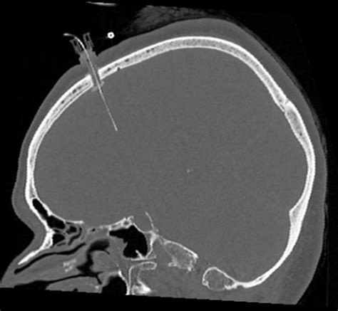 CT scans after implantation of the Licox probe through the plastic ...