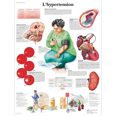 L'hypertension - 1001699 - VR2361L - système cardiovasculaire - 3B Scientific