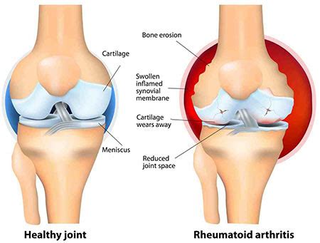 Knee Arthritis Treatment NYC | Arthritis Pain Doctors Specialists in ...