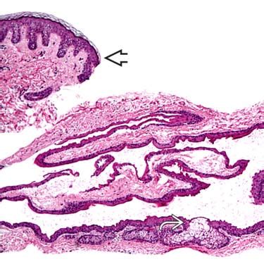 Steatocystoma (Multiplex) | Basicmedical Key