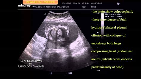 CASE 95 20 WK FETAL HYDROPS ULTRASOUND - YouTube