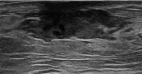 Breast and Axilla | 5.8 Male breast : Case 5.8.1 Gynaecomastia | Ultrasound Cases