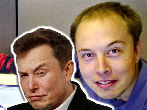 Elon Musk Hair Transplant History and Hair Analysis before and after