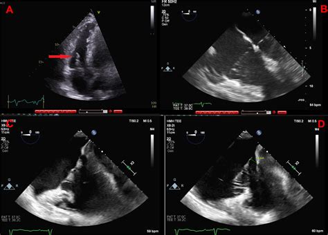 Tricuspid Valve Prolapse: An Uncommon Pathology Revealed by TEE ...