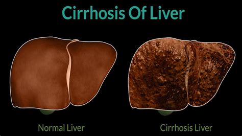 Liver Cirrhosis | Cirrhosis Symptoms | Treatment Of Liver | Causes of cirrhosis - YouTube