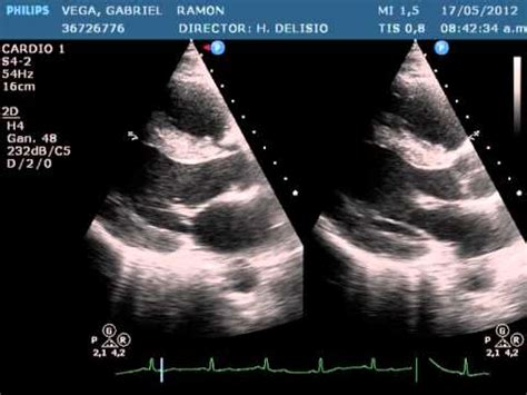 ECOCARDIOGRAMA NORMAL - YouTube