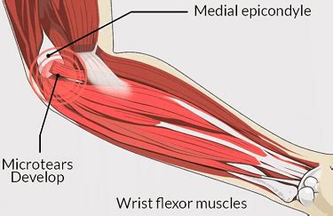 Inner Elbow Pain: Causes, Symptoms & Treatment