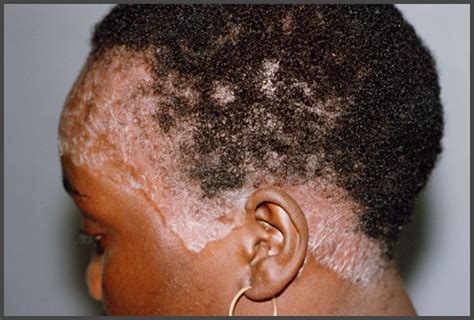 Psoriasis Scalp African American