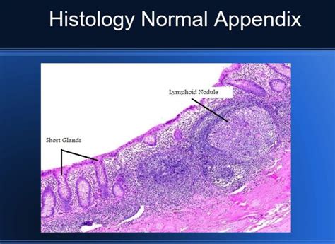 Pathology of Acute Appendicitis - Its Etiology, Morphology, Gross Appearance & Microscopic view ...