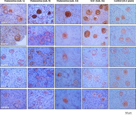 Frontiers | Consequences of β-Thalassemia or Sickle Cell Disease for ...