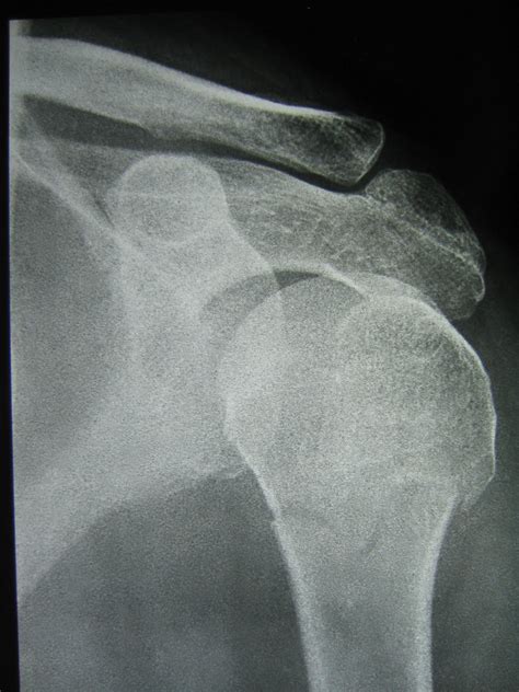 Xray.Shoulder.Fracture (image)