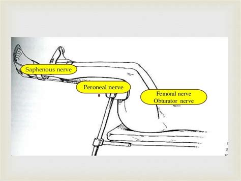 Lithotomy position abdullah