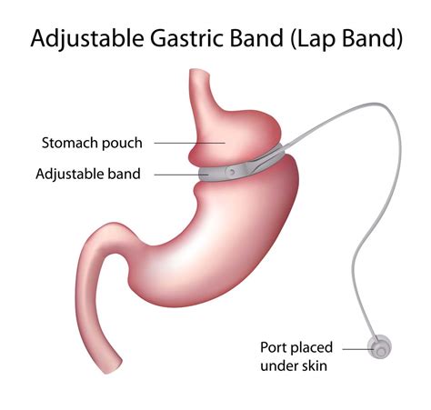 Tijuana, BC Gastric Sleeve or Banding: Weight Loss Surgery Options