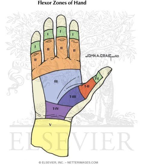 Flexor Tendon Injury Zones - Netter Medical Artwork | Hand therapy, Injury, Occupational therapy