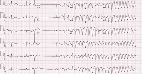 ECG showing sinus bradycardia, first‐degree AV block, premature ...