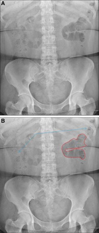 A Abdominal radiograph demonstrating localized ileus. B Sentinel loop ...